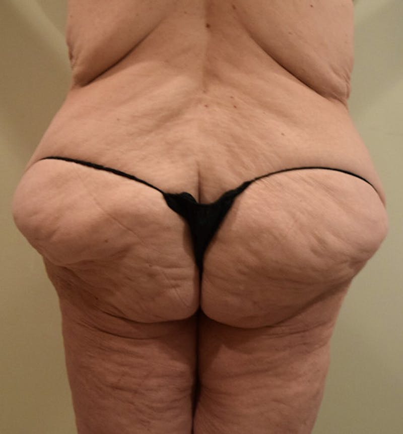 Lower Body Lift Gallery - Patient 102391944 - Image 11