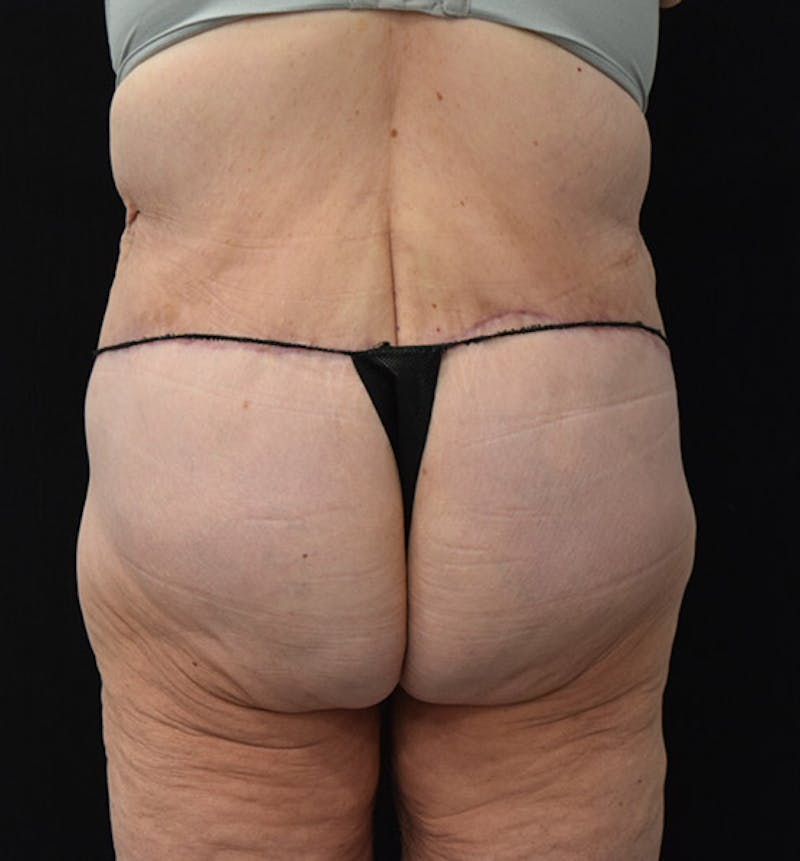 Lower Body Lift Before & After Gallery - Patient 102391944 - Image 12