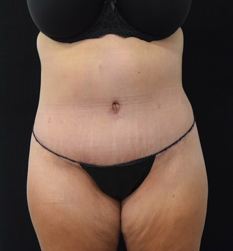 Lower Body Lift Before & After Gallery - Patient 102392074 - Image 2