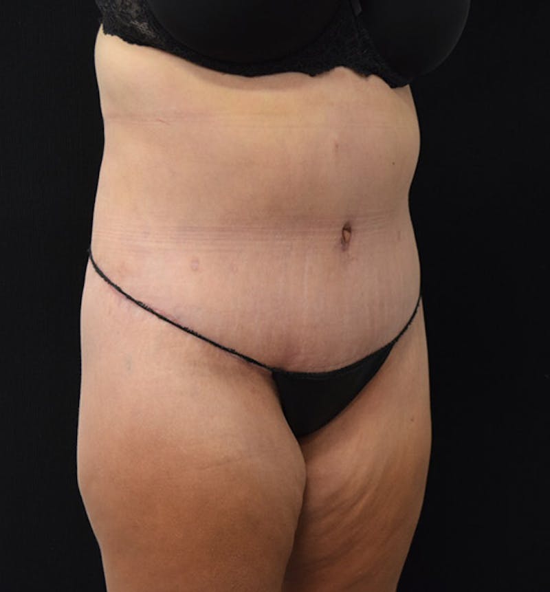 Lower Body Lift Before & After Gallery - Patient 102392074 - Image 4