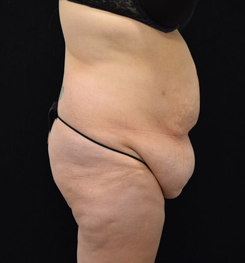 Lower Body Lift Before & After Gallery - Patient 102392074 - Image 5