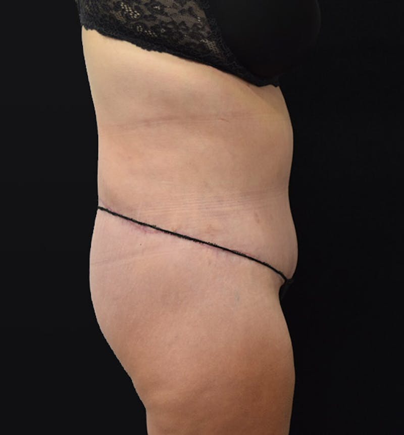 Lower Body Lift Before & After Gallery - Patient 102392074 - Image 6
