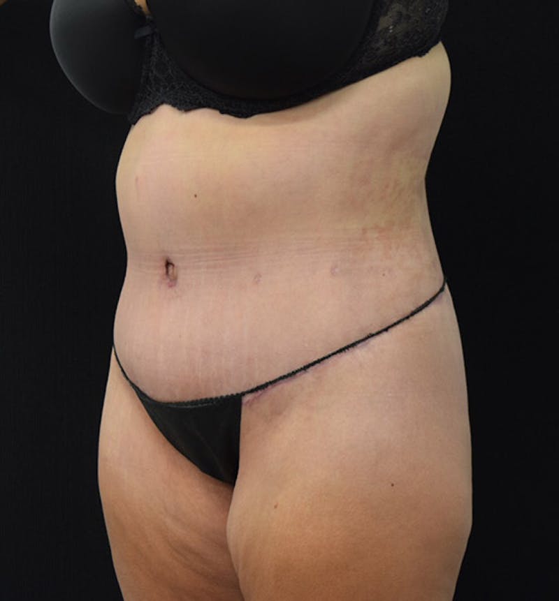 Lower Body Lift Before & After Gallery - Patient 102392074 - Image 8