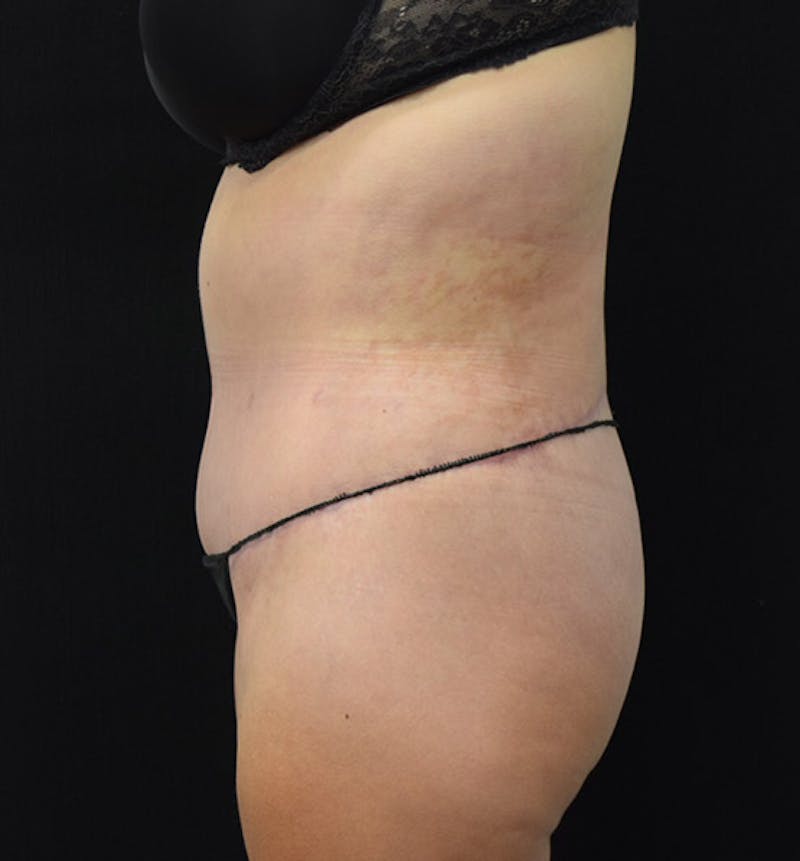 Lower Body Lift Before & After Gallery - Patient 102392074 - Image 10