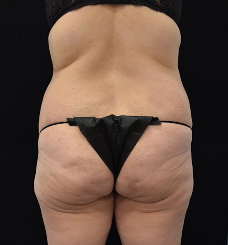 Lower Body Lift Before & After Gallery - Patient 102392074 - Image 11