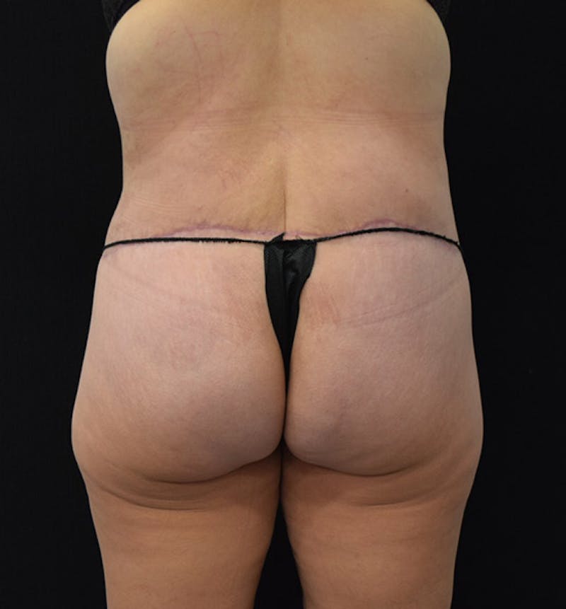 Lower Body Lift Before & After Gallery - Patient 102392074 - Image 12