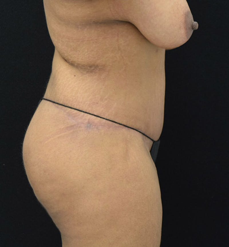 Lower Body Lift Before & After Gallery - Patient 102392118 - Image 6