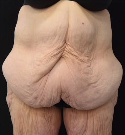 Lower Body Lift Before & After Gallery - Patient 102392245 - Image 1