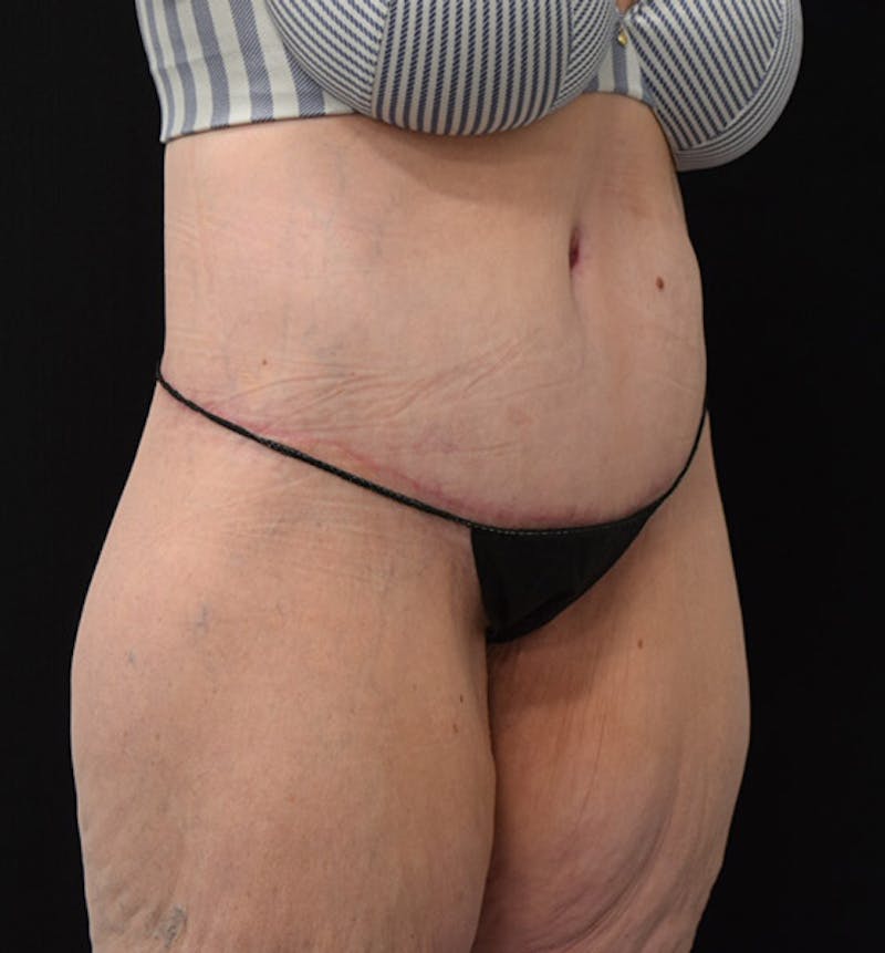 Lower Body Lift Gallery - Patient 102392245 - Image 4