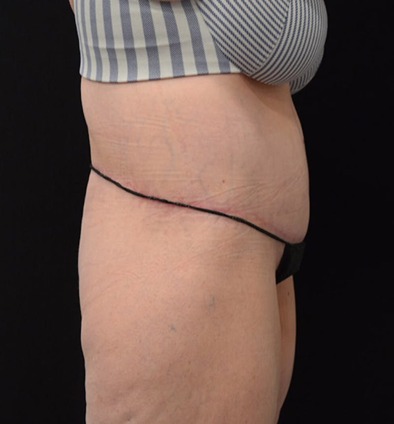 Lower Body Lift Before & After Gallery - Patient 102392245 - Image 6