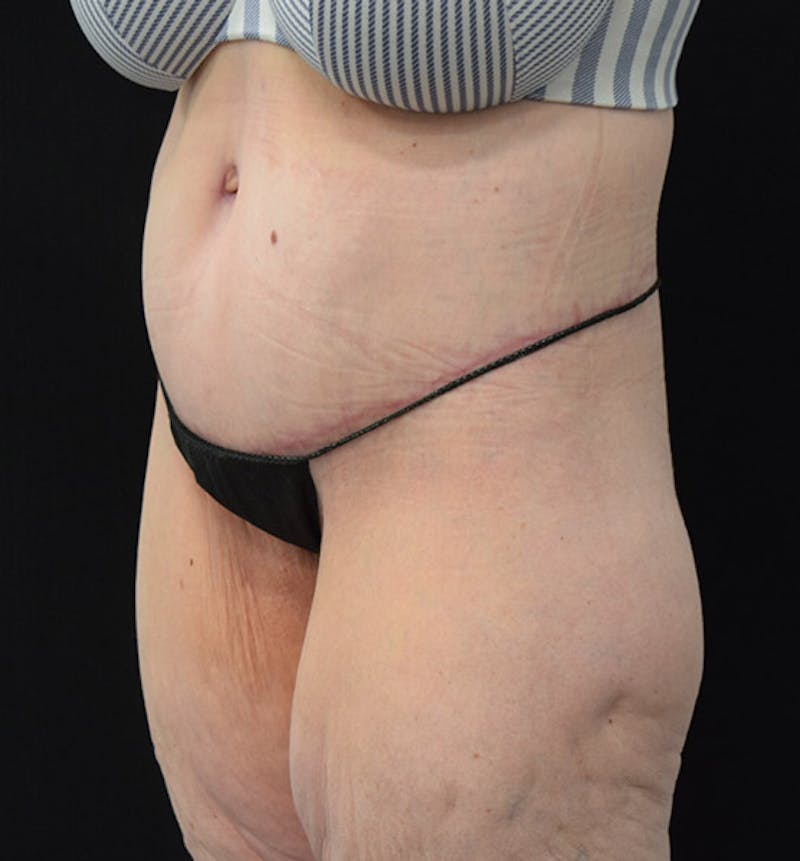 Lower Body Lift Before & After Gallery - Patient 102392245 - Image 8