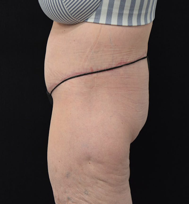 Lower Body Lift Before & After Gallery - Patient 102392245 - Image 10