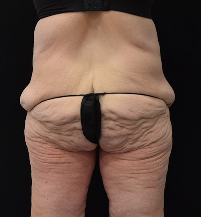 Lower Body Lift Before & After Gallery - Patient 102392245 - Image 11