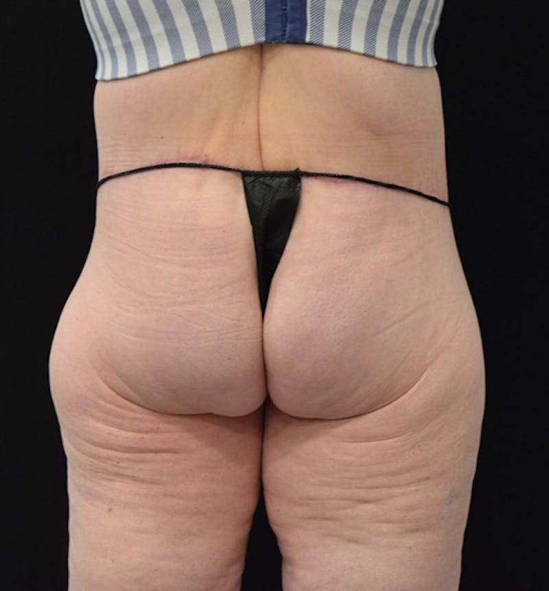 Lower Body Lift Before & After Gallery - Patient 102392245 - Image 12