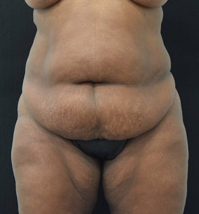 Lower Body Lift Before & After Gallery - Patient 102392448 - Image 1