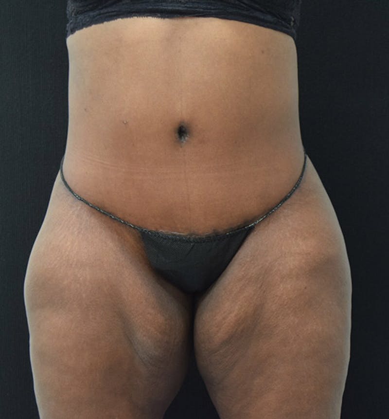 Lower Body Lift Before & After Gallery - Patient 102392448 - Image 2