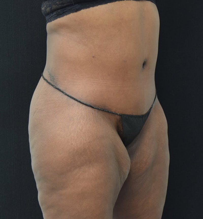 Lower Body Lift Before & After Gallery - Patient 102392448 - Image 4