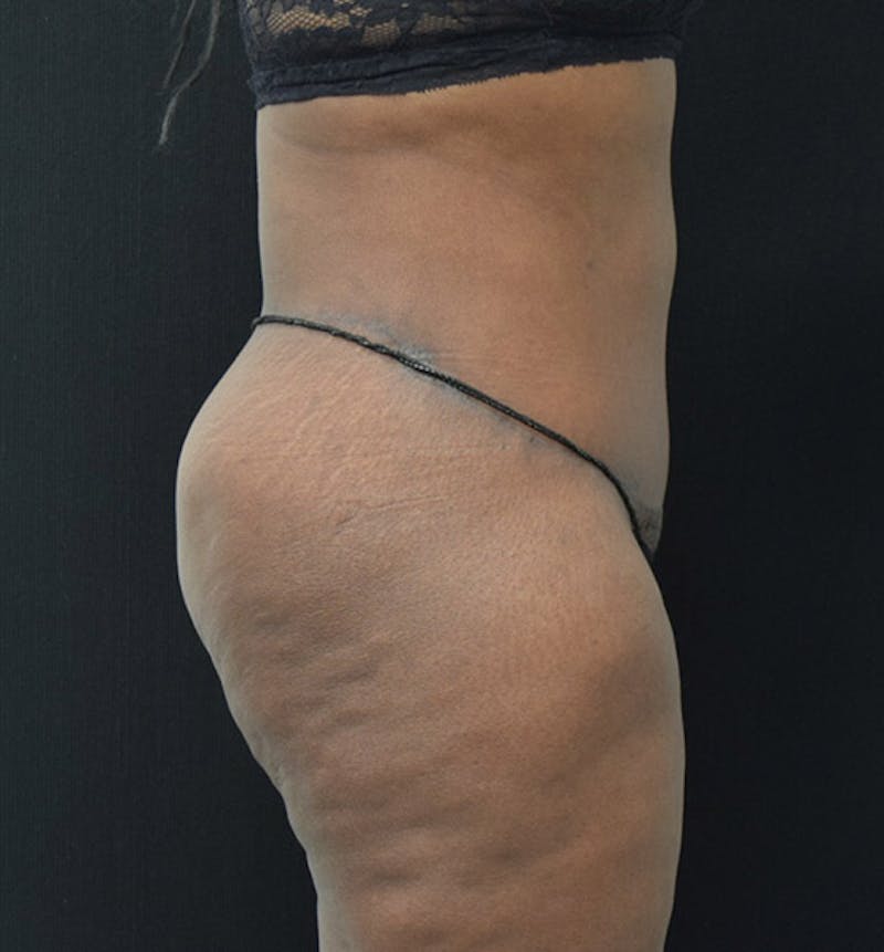Lower Body Lift Before & After Gallery - Patient 102392448 - Image 6