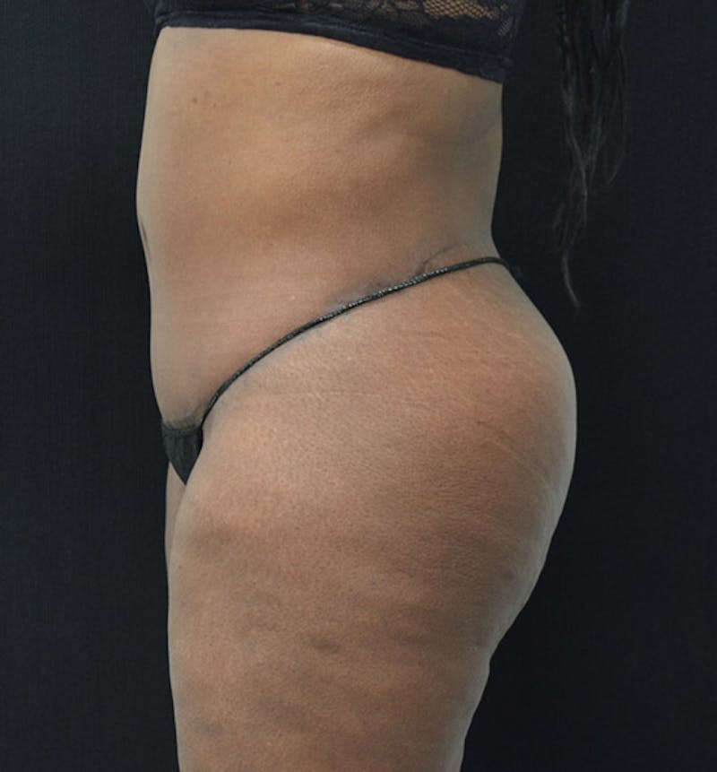 Lower Body Lift Before & After Gallery - Patient 102392448 - Image 10