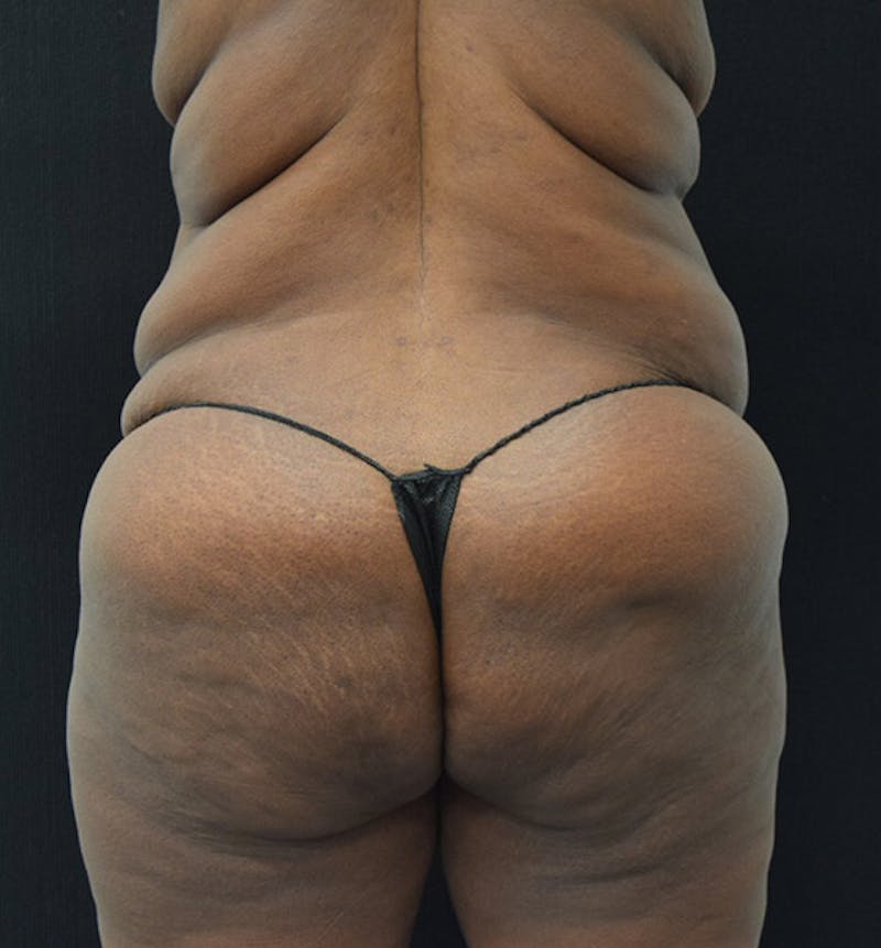Lower Body Lift Before & After Gallery - Patient 102392448 - Image 11