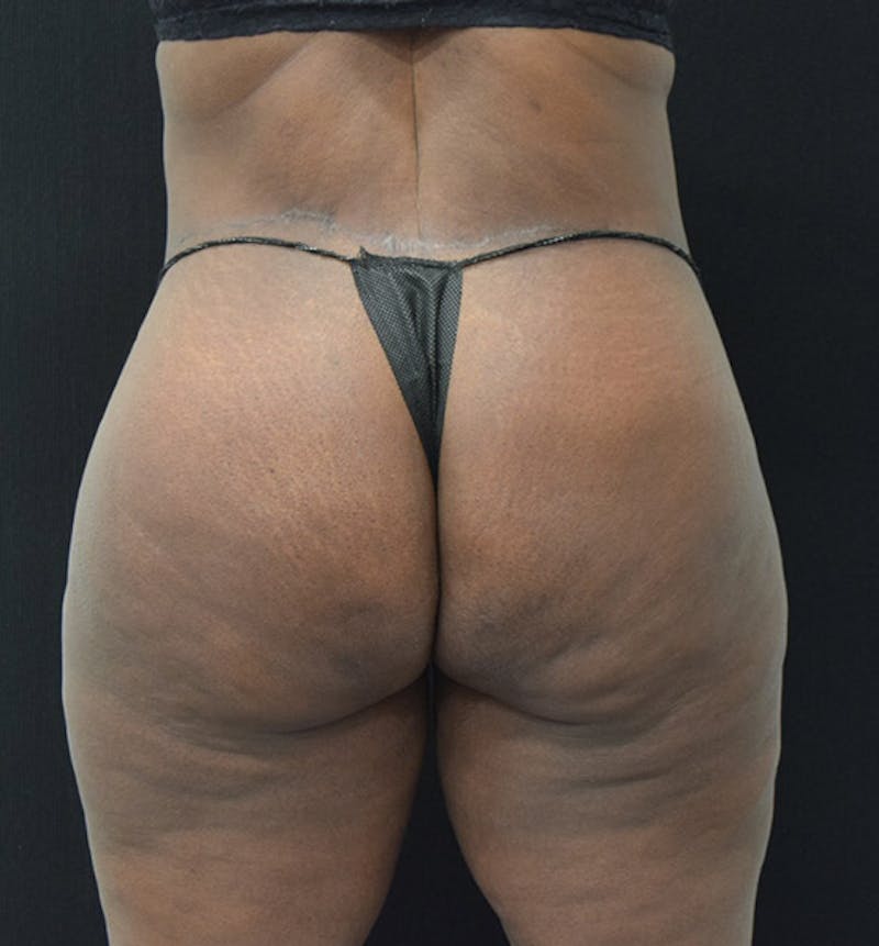 Lower Body Lift Before & After Gallery - Patient 102392448 - Image 12