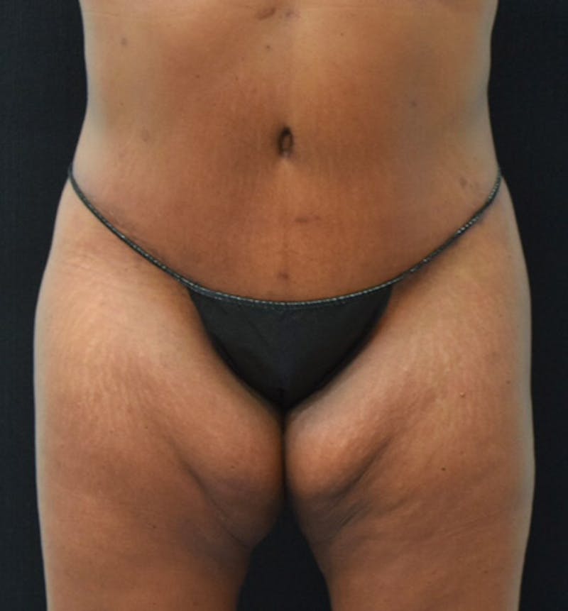 Lower Body Lift Before & After Gallery - Patient 102392473 - Image 2