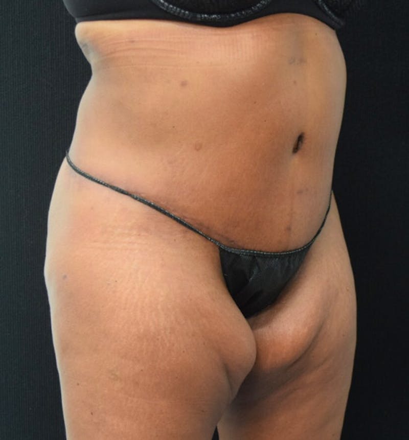Lower Body Lift Before & After Gallery - Patient 102392473 - Image 4