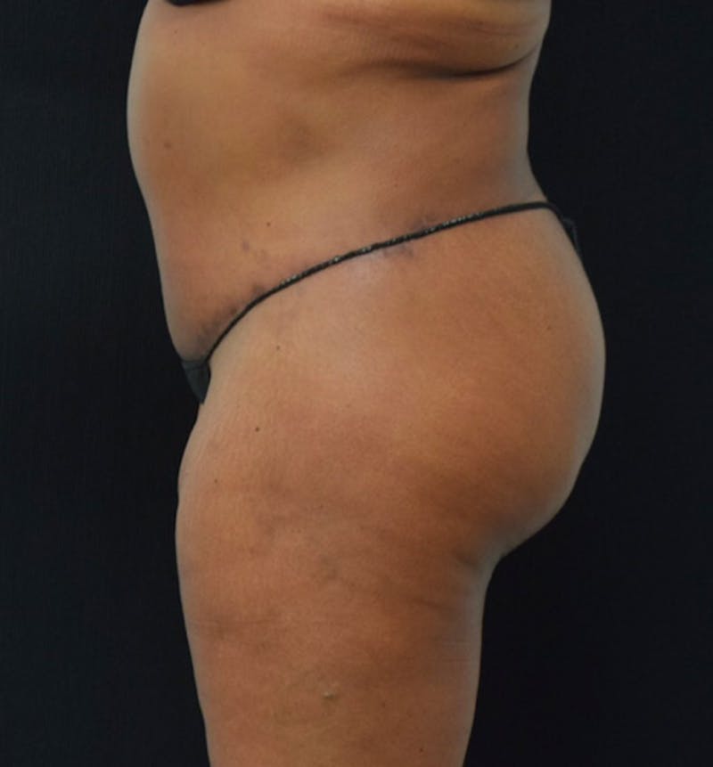 Lower Body Lift Before & After Gallery - Patient 102392473 - Image 10