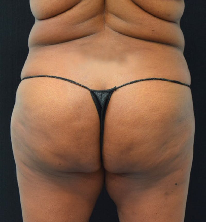 Lower Body Lift Before & After Gallery - Patient 102392473 - Image 11