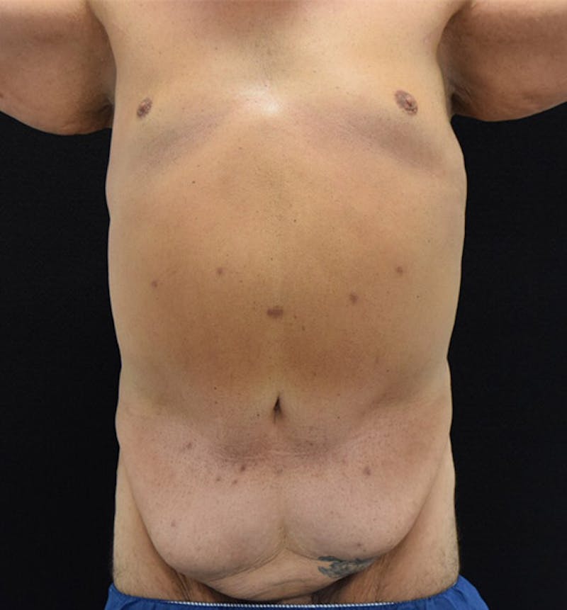 Male Lower Body Lift Before & After Gallery - Patient 148037522 - Image 1