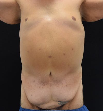 Lower Body Lift Before & After Gallery - Patient 148037522 - Image 1