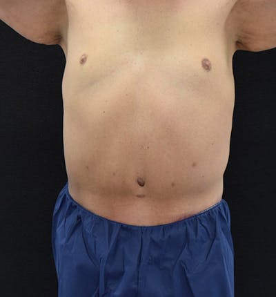 Male Lower Body Lift Before & After Gallery - Patient 148037522 - Image 2