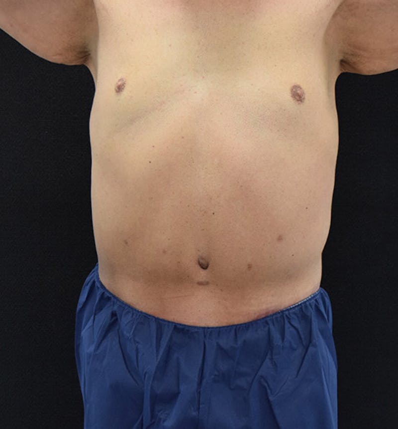 Male Lower Body Lift Before & After Gallery - Patient 148037522 - Image 2