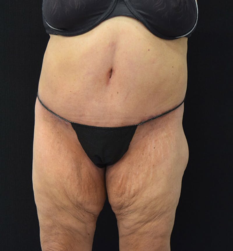 Lower Body Lift Before & After Gallery - Patient 102392550 - Image 2