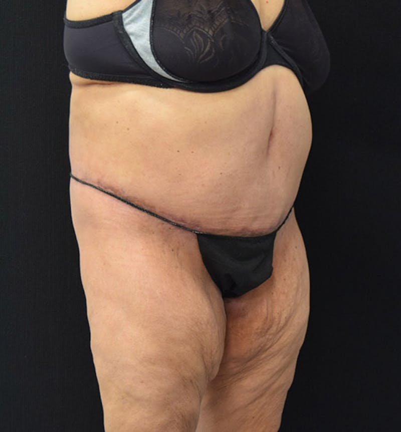 Lower Body Lift Before & After Gallery - Patient 102392550 - Image 4
