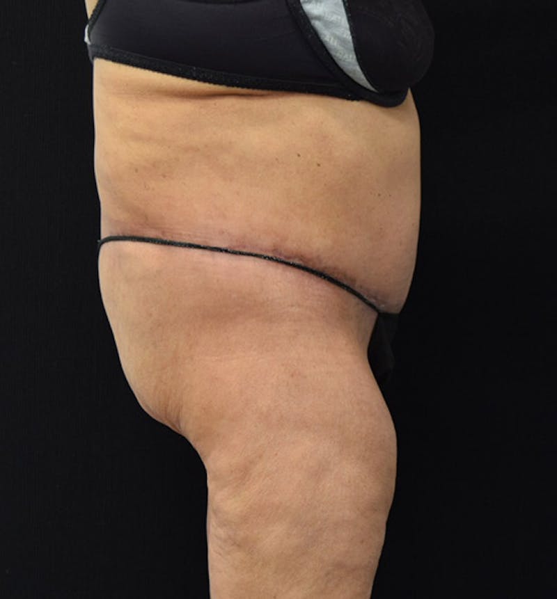 Lower Body Lift Before & After Gallery - Patient 102392550 - Image 6