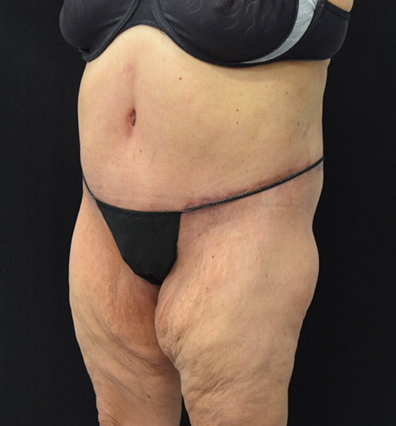 Lower Body Lift Before & After Gallery - Patient 102392550 - Image 8