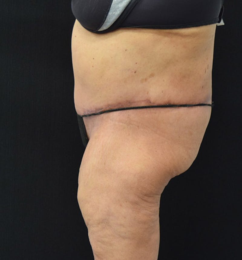 Lower Body Lift Before & After Gallery - Patient 102392550 - Image 10