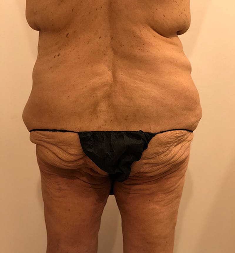 Lower Body Lift Before & After Gallery - Patient 102392550 - Image 11