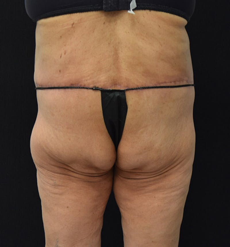 Lower Body Lift Before & After Gallery - Patient 102392550 - Image 12