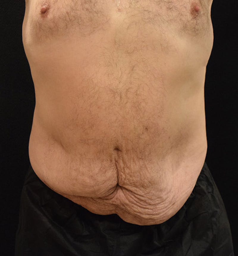 Male Lower Body Lift Before & After Gallery - Patient 148037523 - Image 1