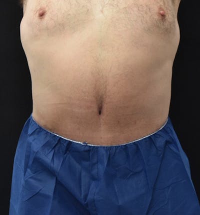 Male Lower Body Lift Before & After Gallery - Patient 148037523 - Image 2