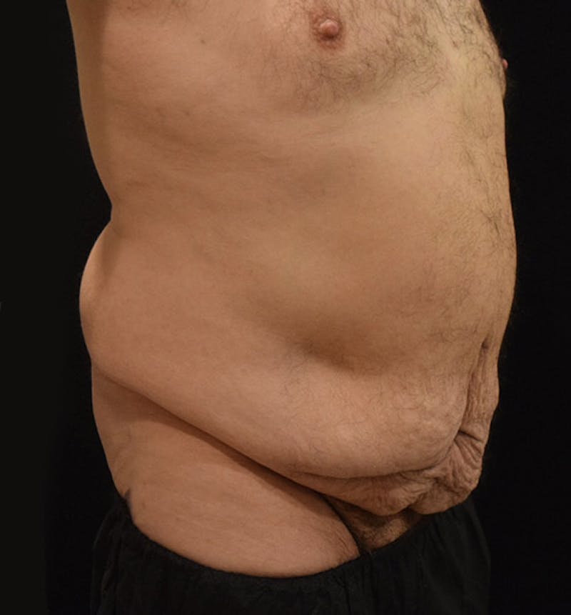 Male Lower Body Lift Before & After Gallery - Patient 148037523 - Image 3