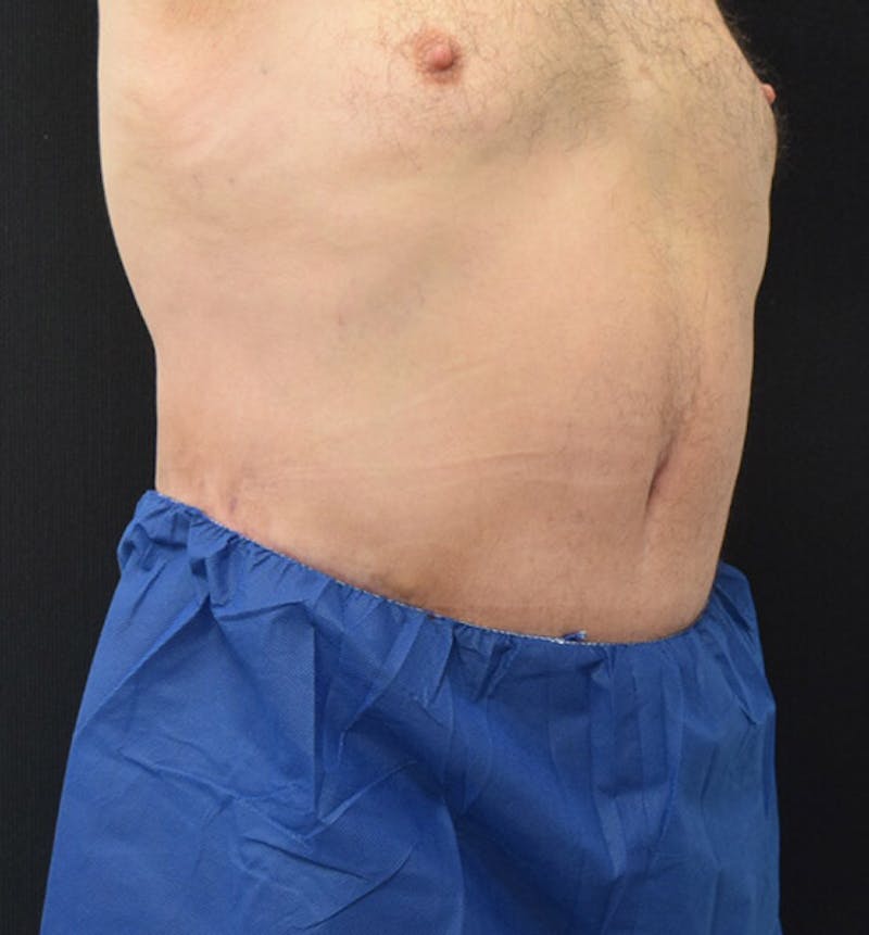 Male Lower Body Lift Before & After Gallery - Patient 148037523 - Image 4