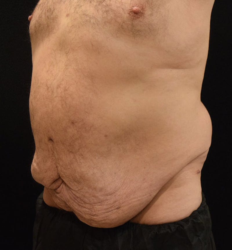 Male Lower Body Lift Before & After Gallery - Patient 148037523 - Image 5