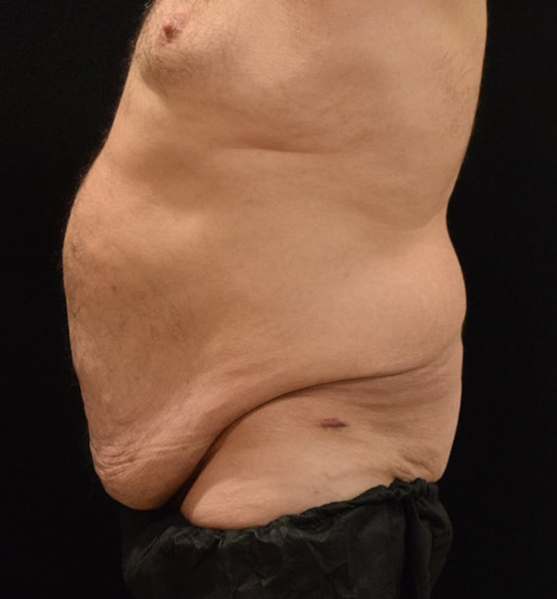 Male Lower Body Lift Before & After Gallery - Patient 148037523 - Image 7