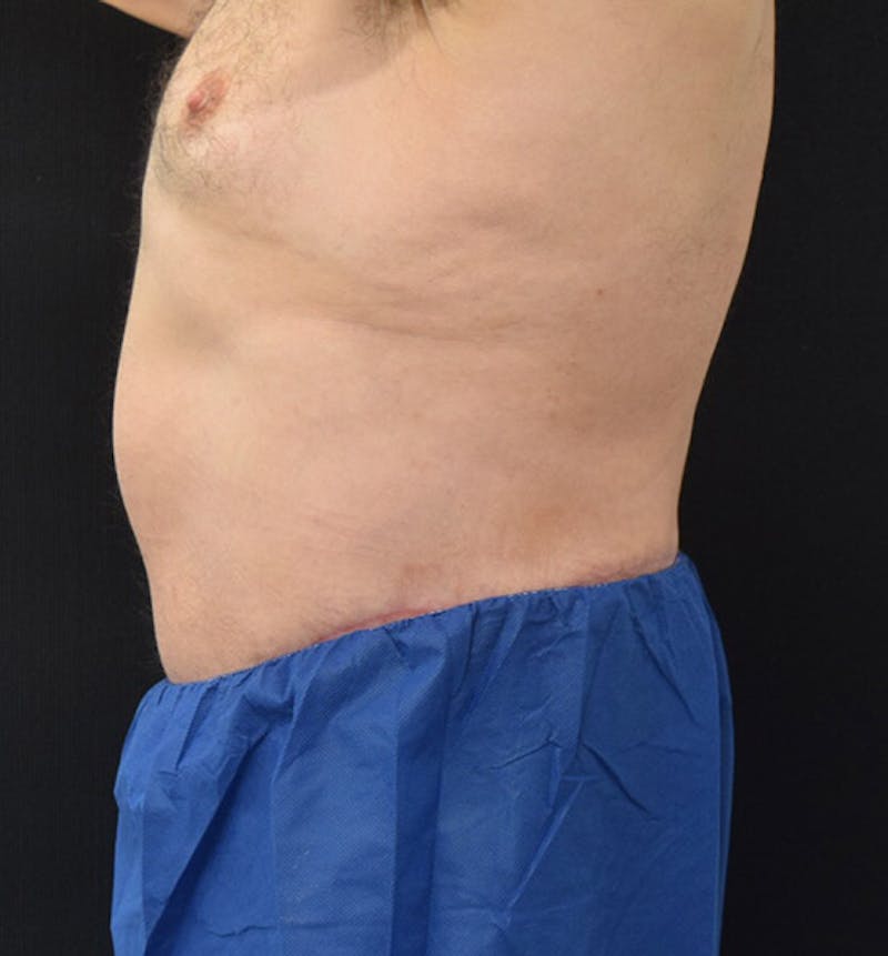 Male Lower Body Lift Before & After Gallery - Patient 148037523 - Image 8