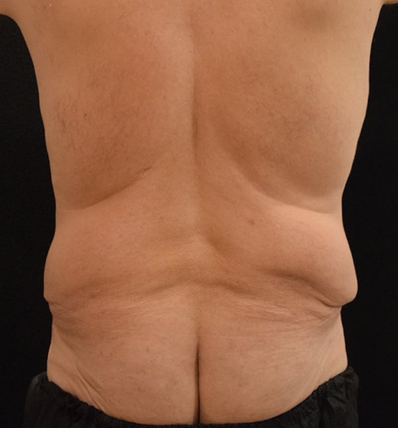 Lower Body Lift Before & After Gallery - Patient 148037523 - Image 9