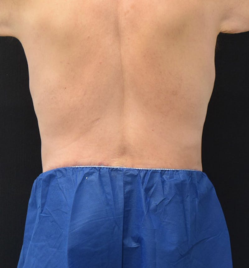 Male Lower Body Lift Before & After Gallery - Patient 148037523 - Image 10