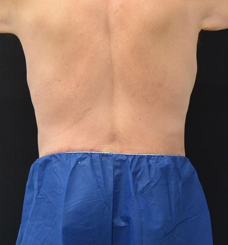 Lower Body Lift Before & After Gallery - Patient 148037523 - Image 10